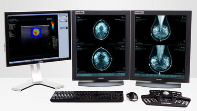 Software Tdm Mevis Medical Solutions Ag Para Mamograf A Cl Nico