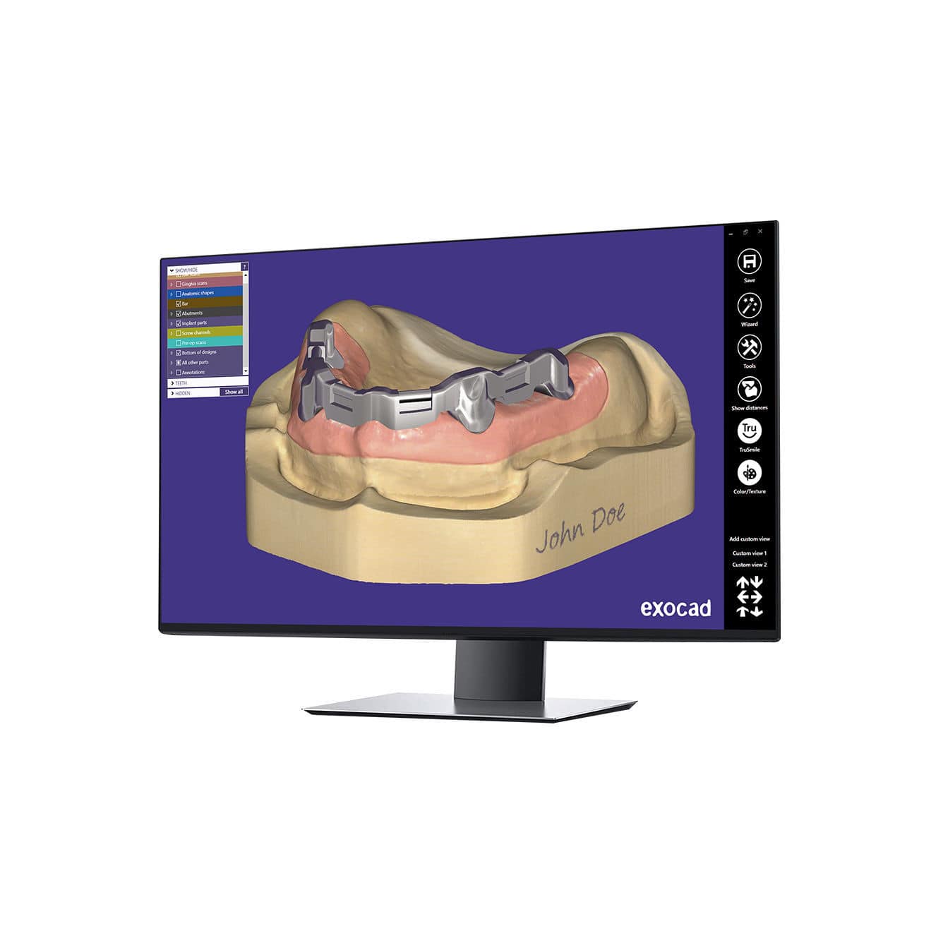 Módulo de software clínico Bar exocad GmbH para odontología de