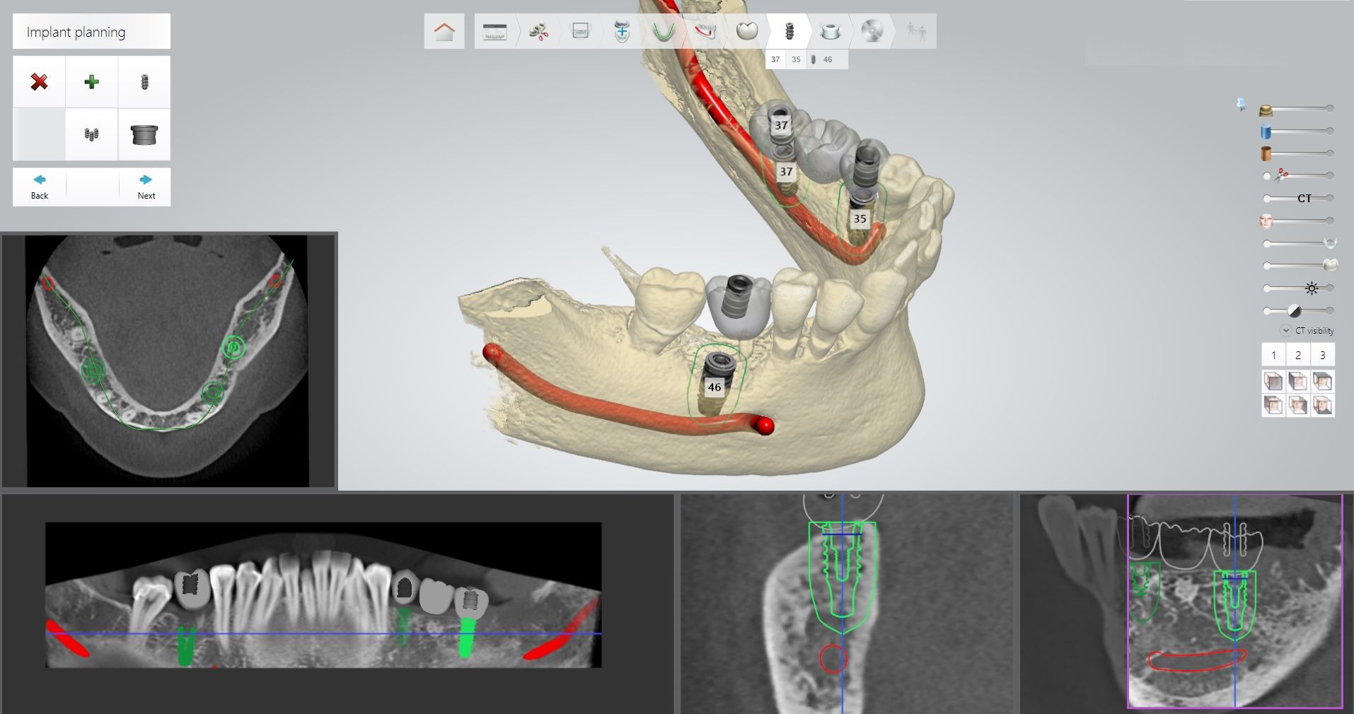 Software Para Cirug A Guiada Thommen Medical Ag De Implantolog A