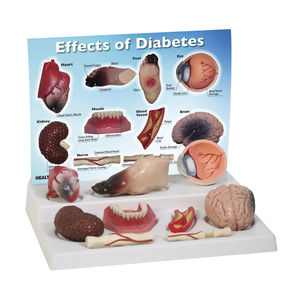 modelo anatómico de diabetes / corazón / pie / riñón