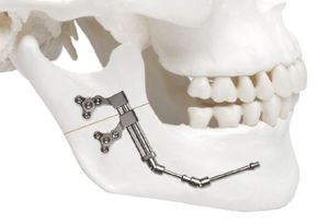 distractor mandibular / interno