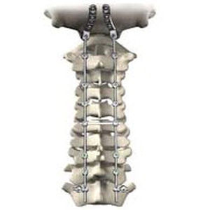 sistema de osteosíntesis occipitocervicotorácico / vía posterior / para adulto
