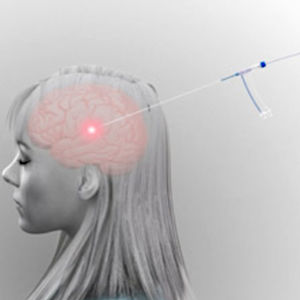 sistema de ablación láser para termoablación láser de tumores cerebrales / guiado por IRM