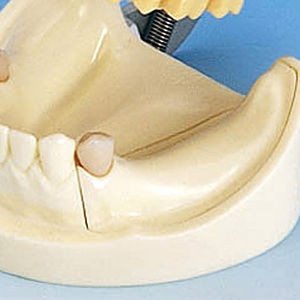 modelo anatómico de dentadura / mandíbula / de implantología / articulado