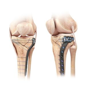placa de compresión tibia / porción proximal
