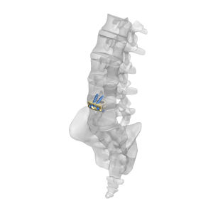 caja intersomática toracolumbar / vía anterior