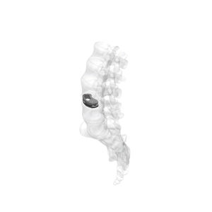 caja intersomática lumbar / vía transforaminal