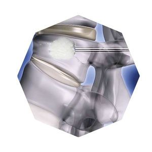 kit de instrumentos para vertebroplastia percutánea