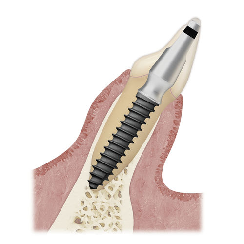 Implante Dental Cil Ndrico Ms Implant Surface Sa Osstem Implant