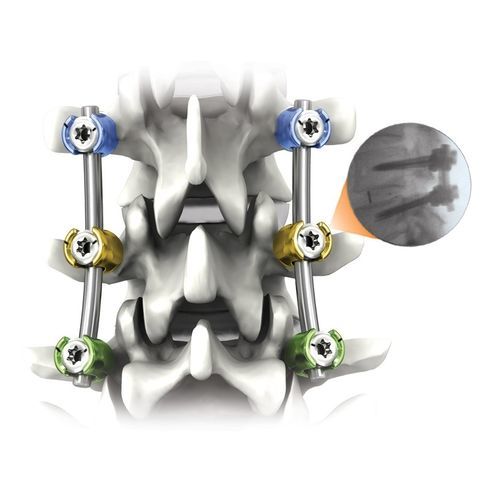 Sistema De Osteos Ntesis Toracolumbar Nautilus Life Spine V A