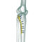 Placa De Compresi N Para Tibia True Lock Proximal Tibia Posteromedial