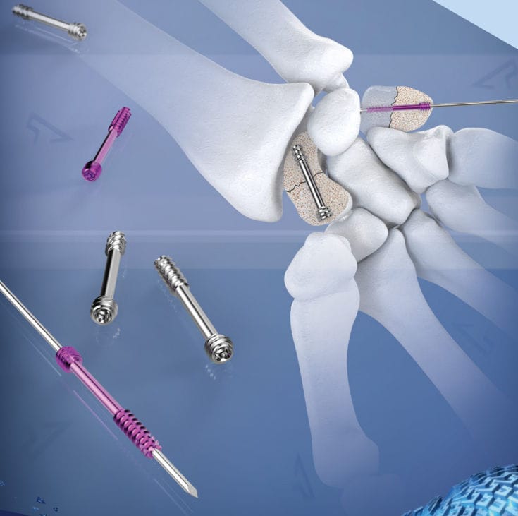 Tornillo de compresión ósea para metacarpo - AGOMED Medizin-Technik ...