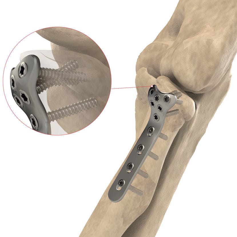 Placa de compresión para cóndilo humeral - AS.E.019 - Ases Orthopedics ...