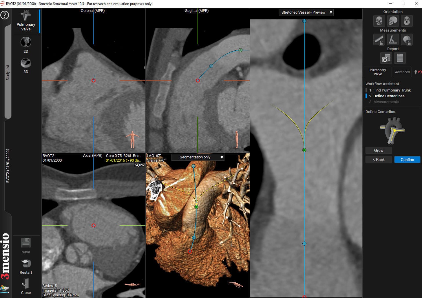 Software de anatomía 3mensio Pulmonary valve Pie Medical Imaging
