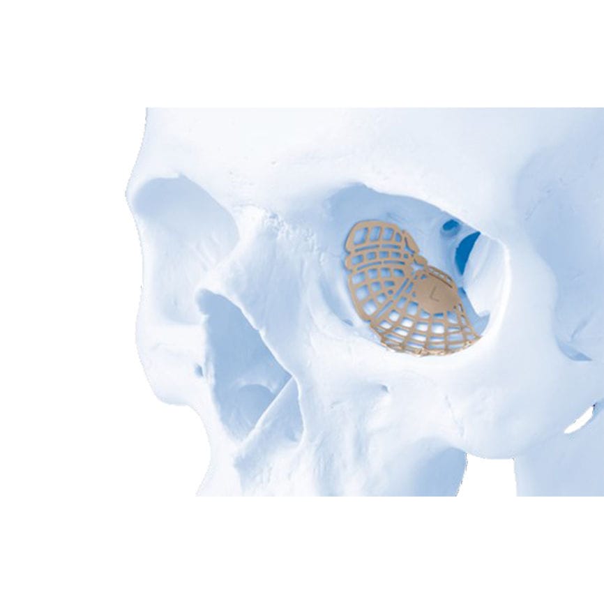 Implante periorbital no reabsorbible MatrixMIDFACE™ Depuy Synthes