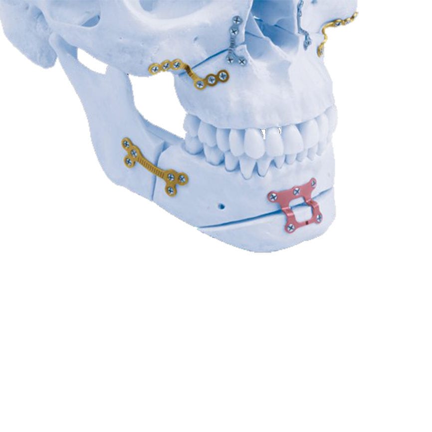 Placa de compresión para mandíbula Matrix ORTHOGNATHIC™ Depuy