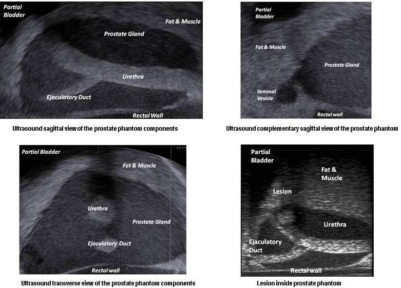 ecografia de prostata rectal