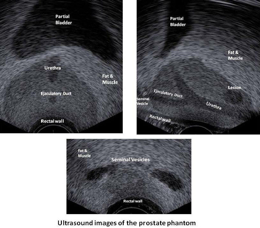 condiciones para ultrasonido de prostata