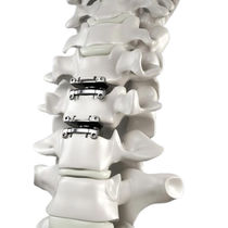 Prótesis de disco cervical
