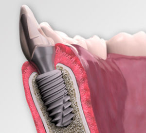 implante dental cónico