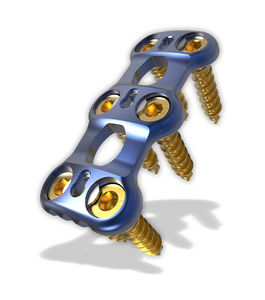 placa de artrodesis cervical 1