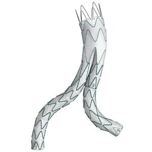 stent-injerto aorta abdominal 1