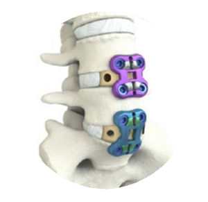 placa de artrodesis lumbar