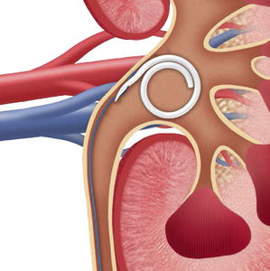 stent ureteral 1