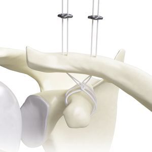 botón de sutura para la reconstrucción del ligamento acromioclavicular 1