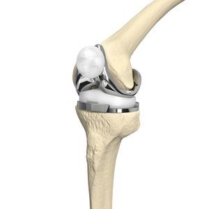 prótesis de rodilla tricompartimental