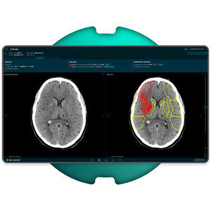 software para diagnóstico de ictus