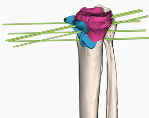 plantilla de resección para osteotomía tibial