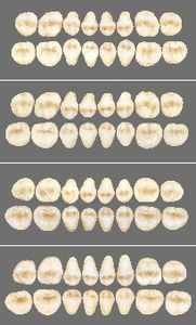 prótesis dental de fibra acrílica