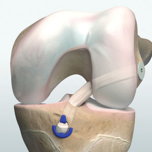 kit de instrumentos para reconstrucción del ligamento cruzado anterior 1