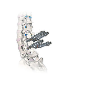 sistema de osteosíntesis toracolumbar 1