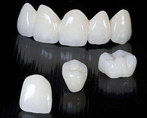 puente dental de circona