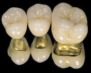 corona dental de PFM