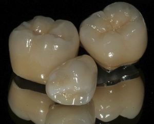 corona dental de PFM