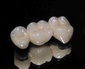Corona dental de PFM - CLASSIC - Derby Dental - de los dientes