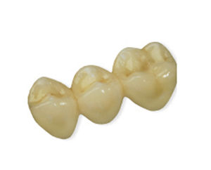 puente dental de PMMA