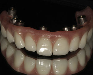 prótesis dental de fibra acrílica