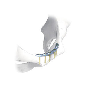 placa de compresión para pelvis 1