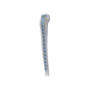 placa de compresión para tibia 1
