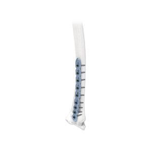 tornillo de compresión ósea para radio