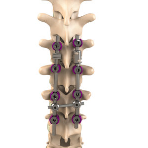 sistema de osteosíntesis toracolumbar