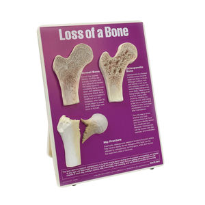 kit de presentación de modelos anatómicos de osteoporosis