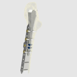 placa de compresión para fractura femoral periprotésica