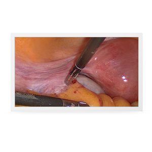 monitor para endoscopia
