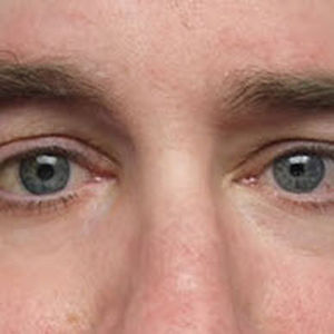 prótesis estética esterna orbital