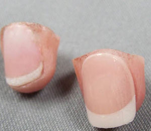prótesis estética esterna de dedo